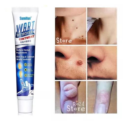 CREMA REMOVEDOR DE VERRUGAS